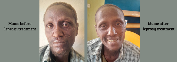 Mume before leprosy treatment
